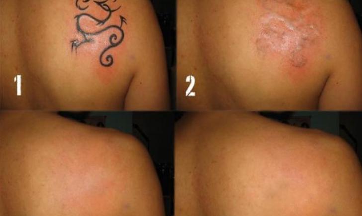 Courtesy X Tattoo Removal